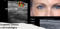 Ecografía cutánea estética y dermatológica