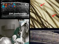 Trasplante capilar - Técnica FUE-DHI